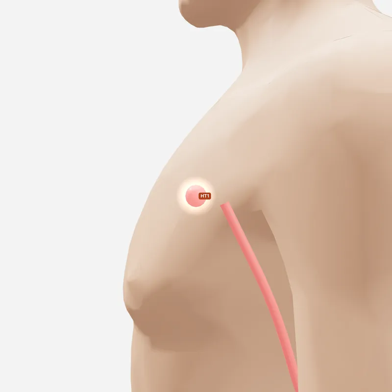 Huyệt Cực Tuyền — trên da