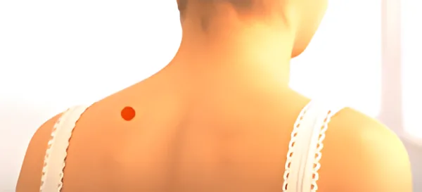 Sơ đồ huyệt Khúc Viên