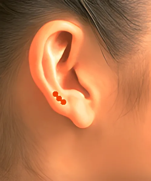 Sơ đồ huyệt Nhĩ Bình Ngoại Tam Huyệt