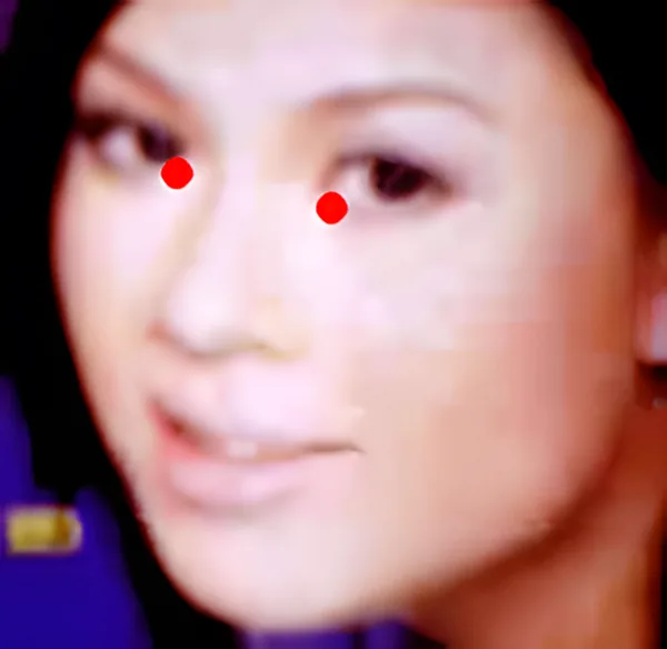 Sơ đồ huyệt Nội Tinh Minh